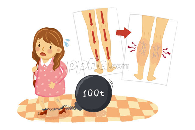 하지정맥류 이미지 미리보기